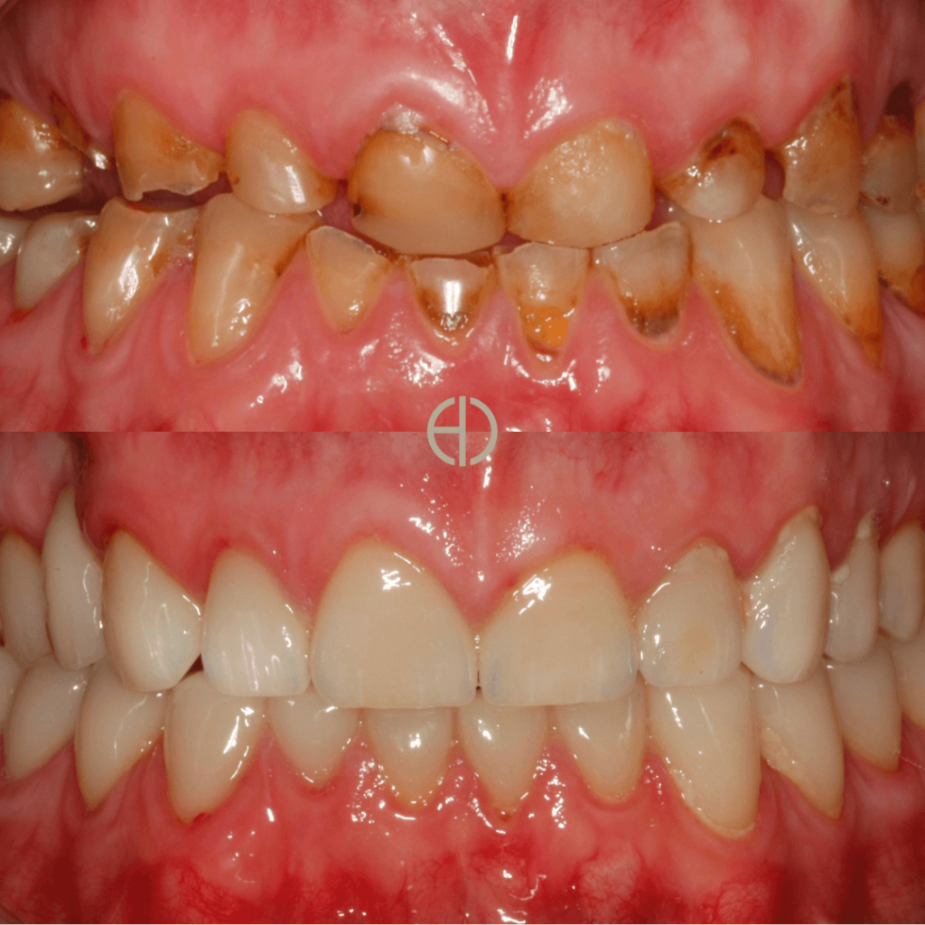 Before and After
