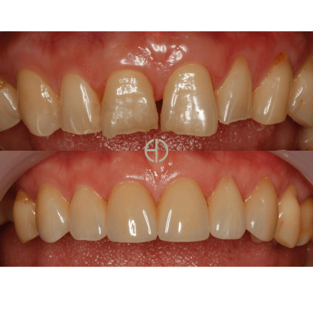 Before and After